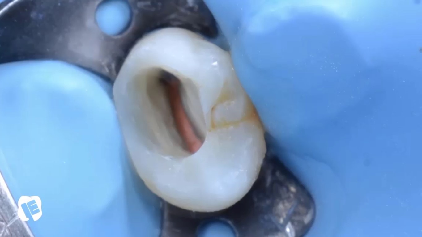 ترمیم دندان پس از روت کانال تراپی