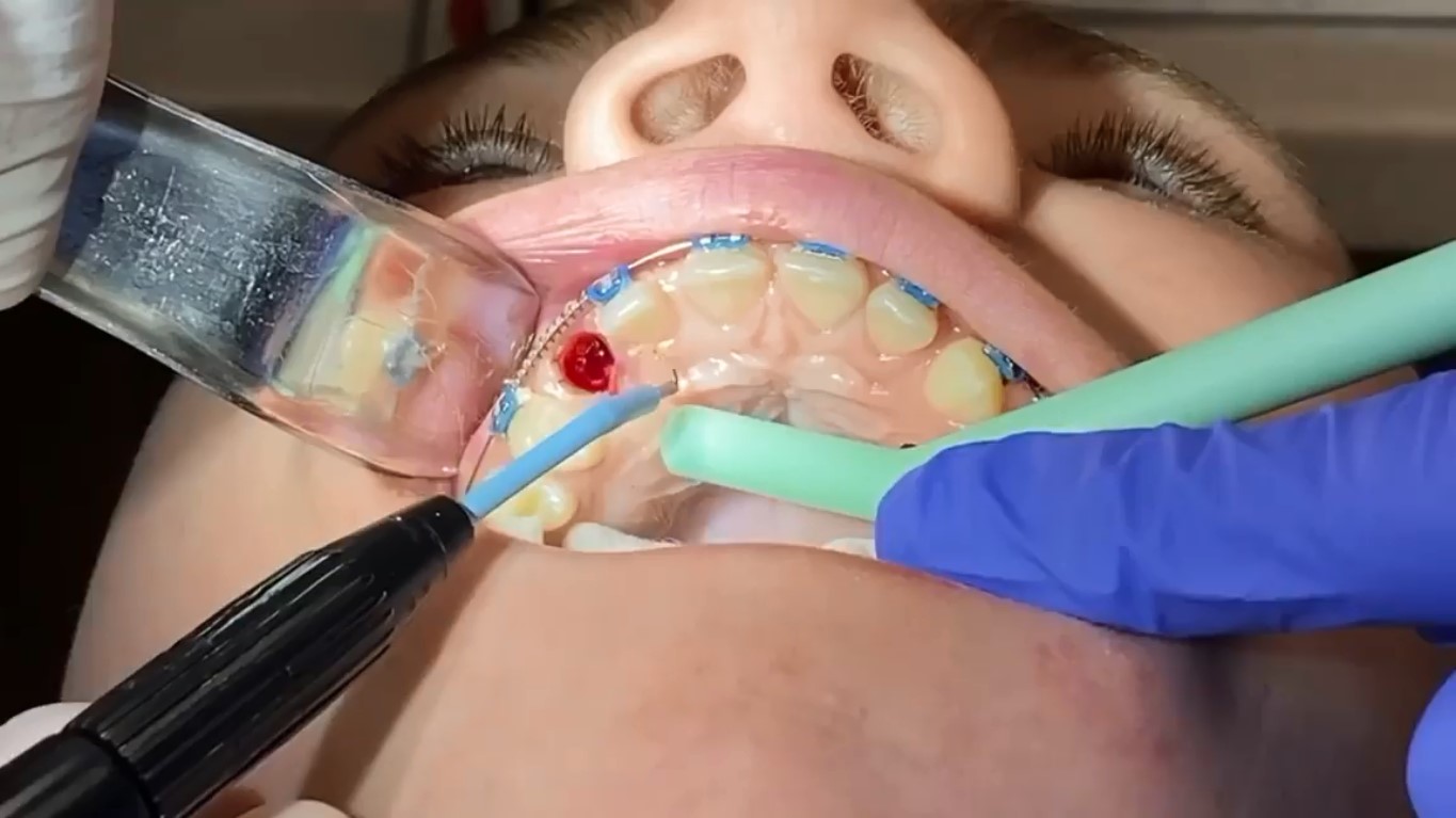 جراحی اکسپوز کردن دندان کانین نهفته