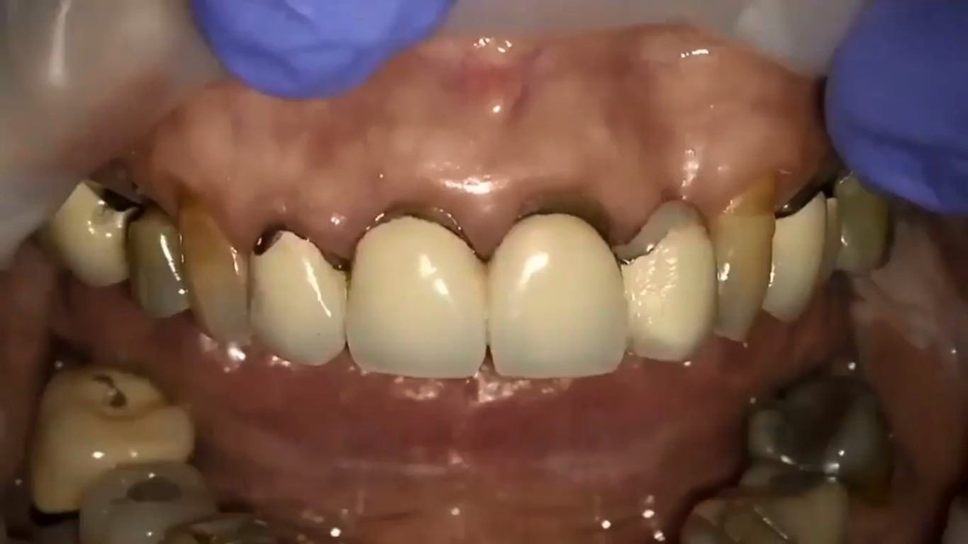 افزایش طول تاج و بازسازی دندانها