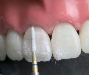 ویدئوی پرداخت و پالیش کامپوزیت دندانهای قدامی