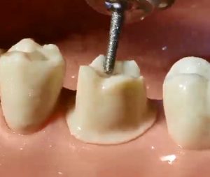 آماده سازی و تراش دندان مولار برای روکش