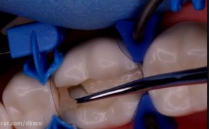 ترمیم دندان خلفی با کامپوزیت – دکتر مونا نوروزی
