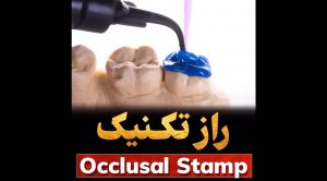 راز تکنیک Occlusal Stamp