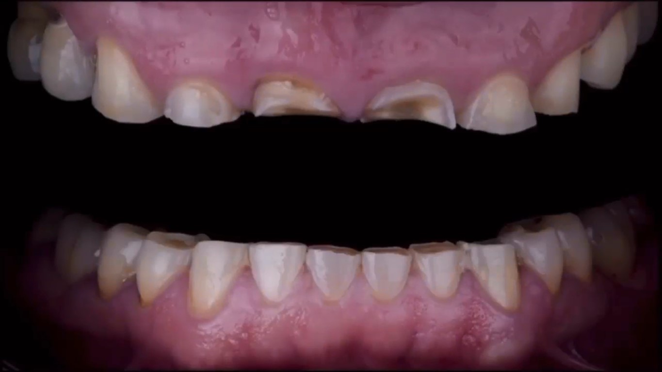 بازسازی کامل دهان با استفاده از تزریق کامپوزیت فلو