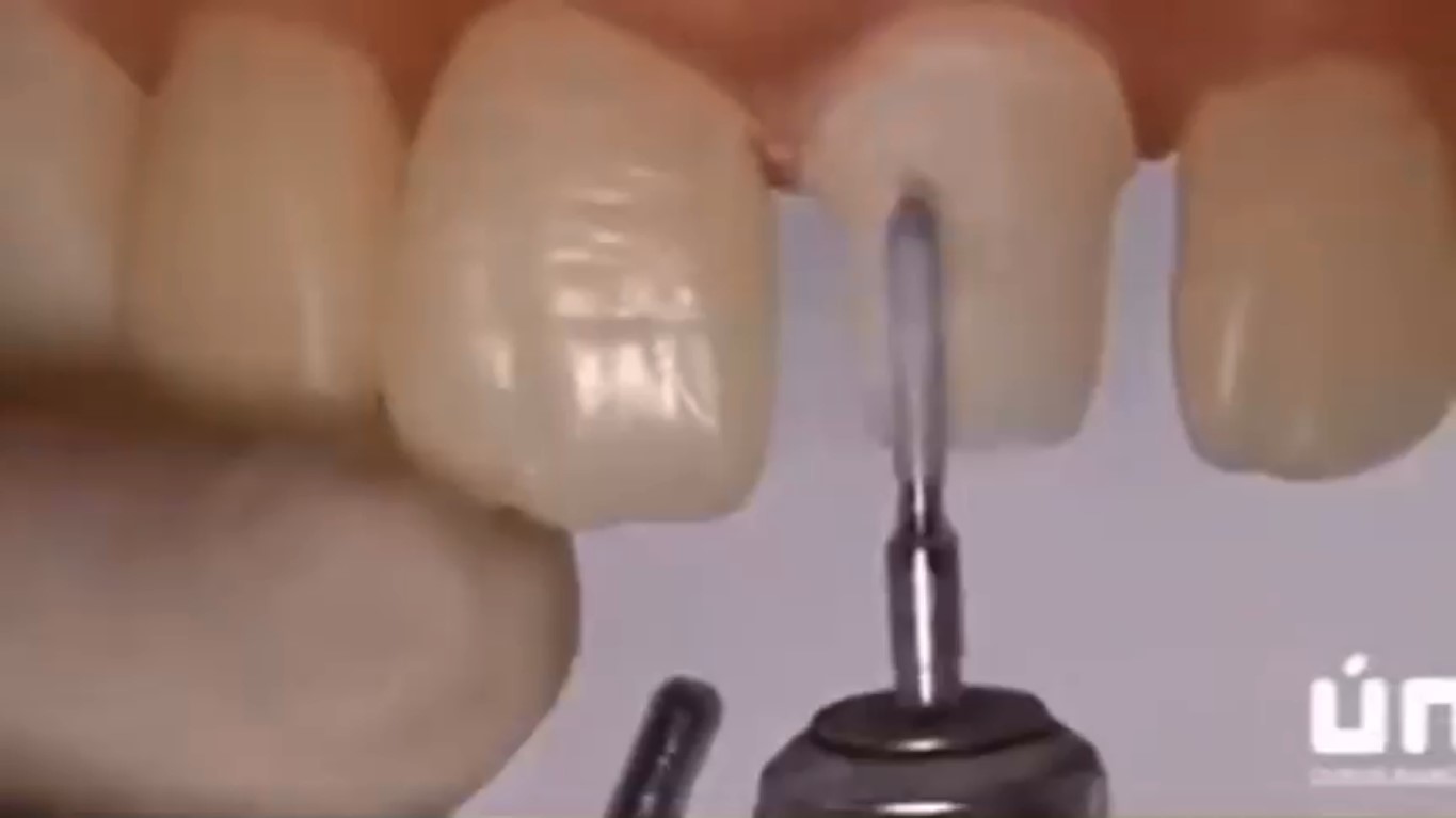 تراش دندان سانترال برای ساخت روکش